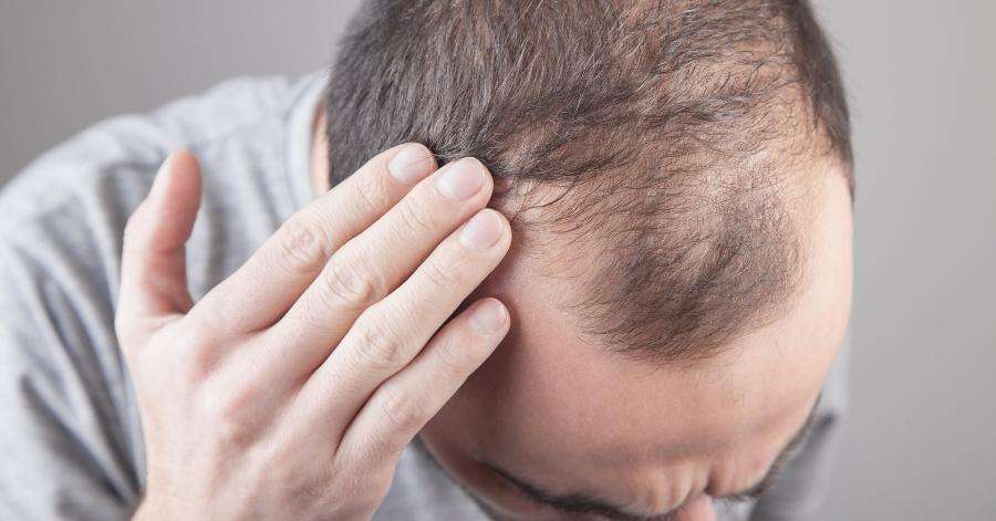 Men’s Hair Loss - Main Points