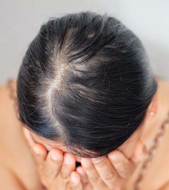 Hair Loss Basics -Main Points