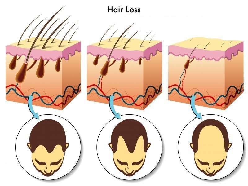 Dihydrotestosterone (DHT) Blockers